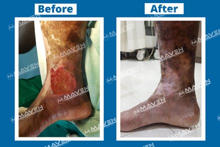 Varicose Veins Before After Photos
