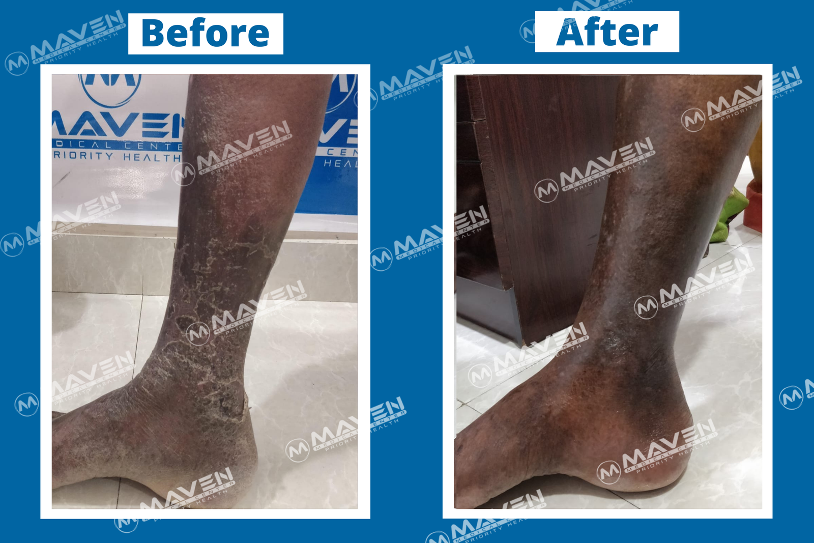 Varicose Veins Before After Photos