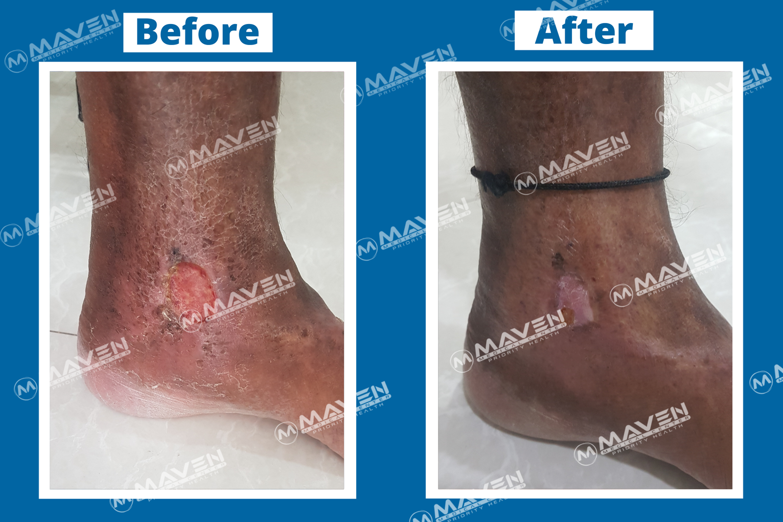 Varicose Veins treatment Before After 
