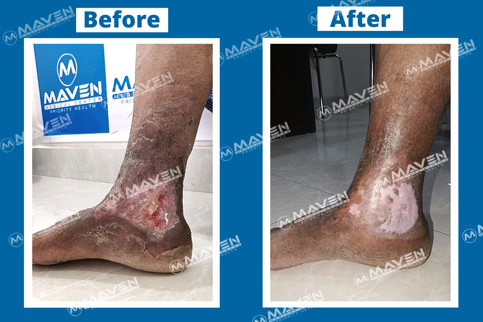 Varicose Veins Before After Photos