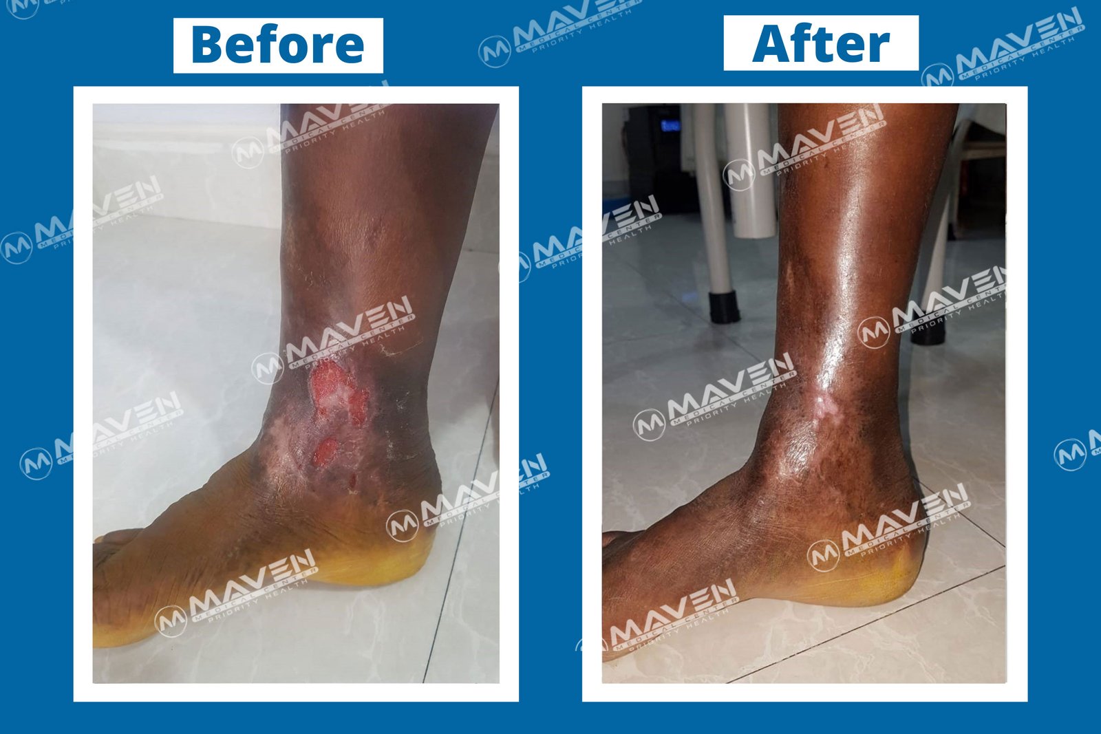 Varicose Veins Before After Photos