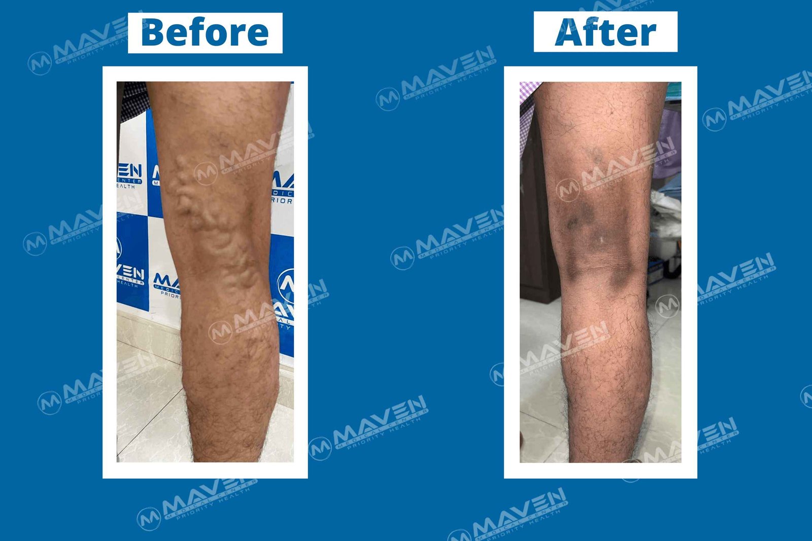 varicose-veins-before-after-pic57