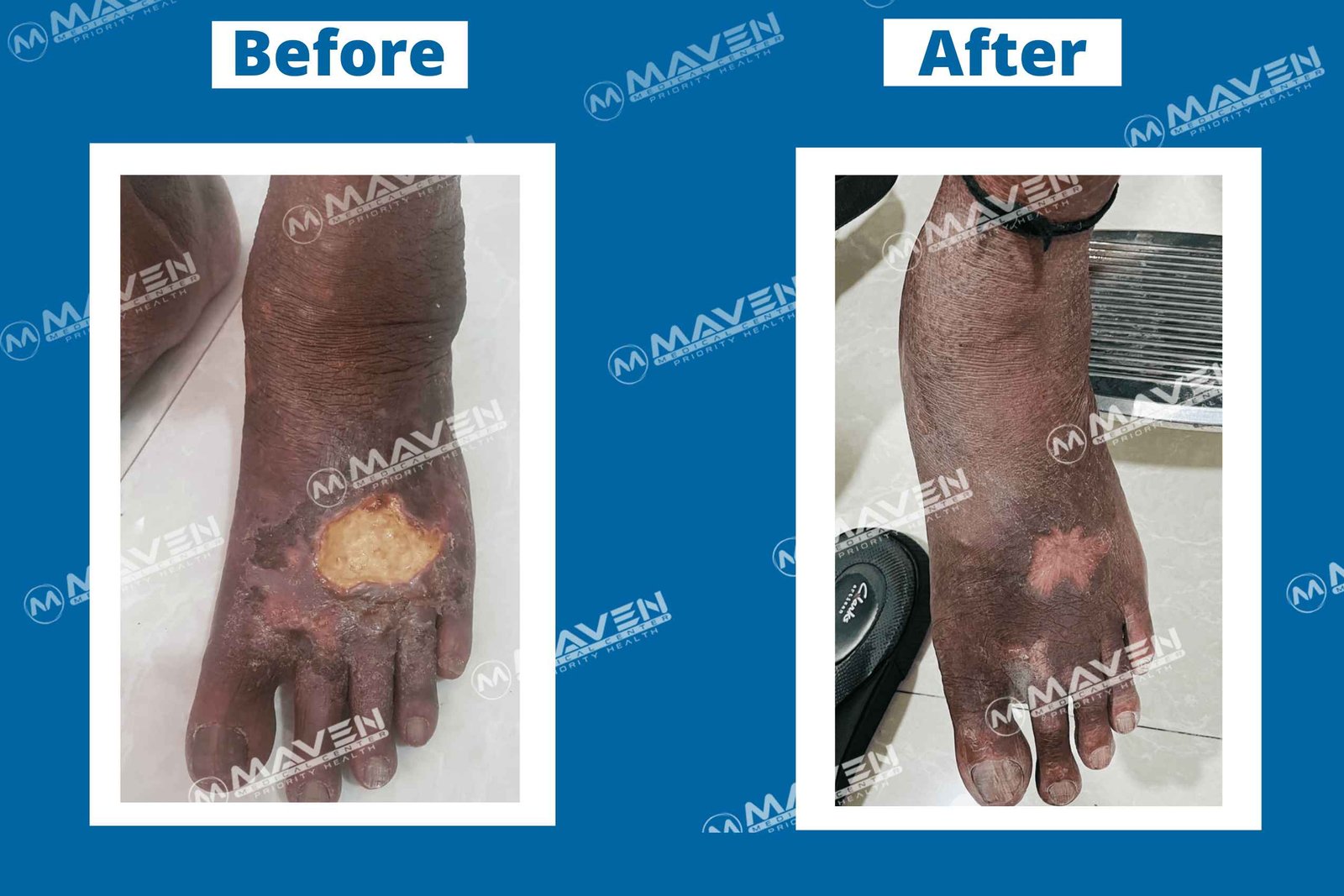 varicose-veins-before-after-pic59