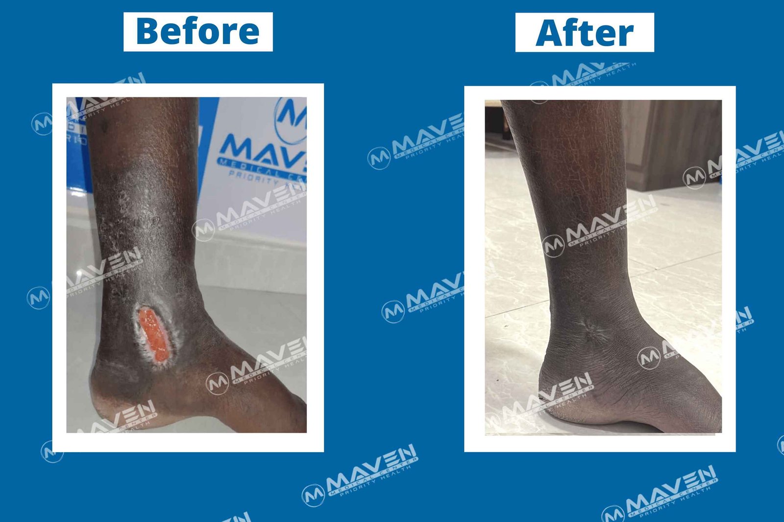 varicose-veins-before-after-pic62