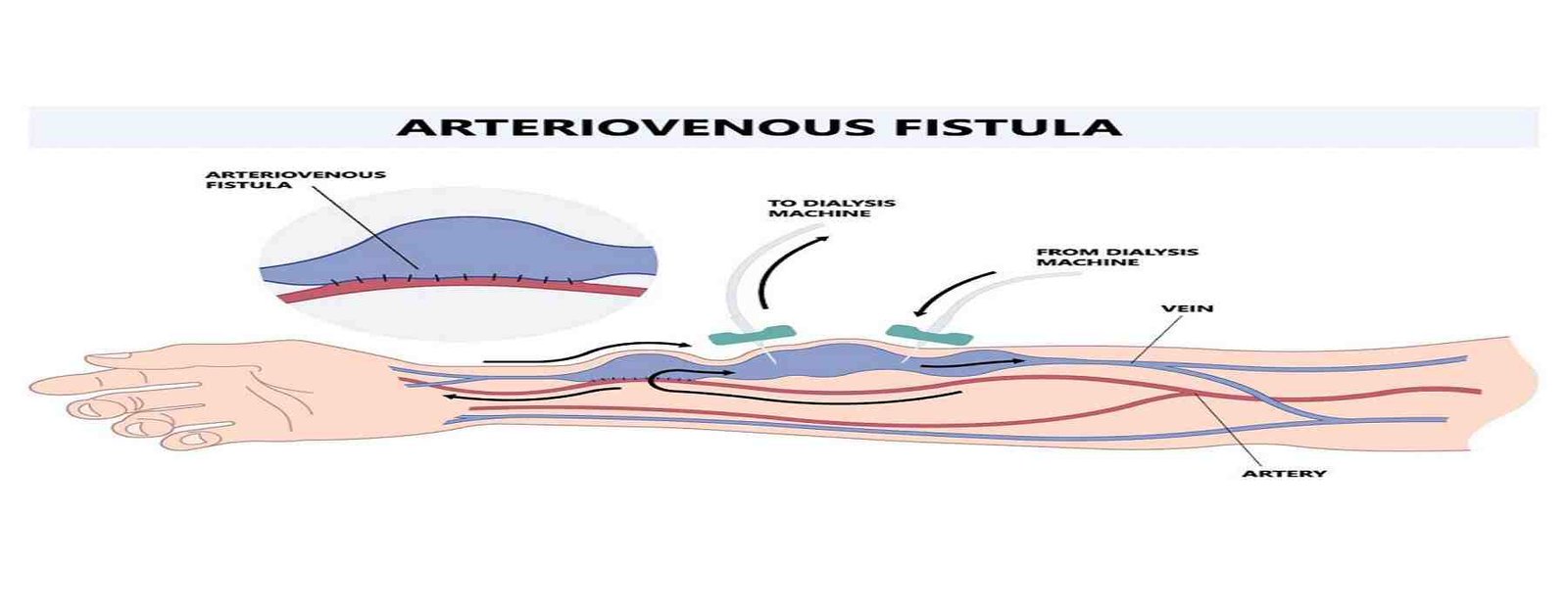 Av Fistula Surgery Cost In Hyderabad Maven Medical Center