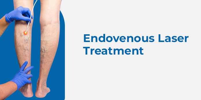 Endovenous Laser Treatment (EVLT or EVLA) Procedure 