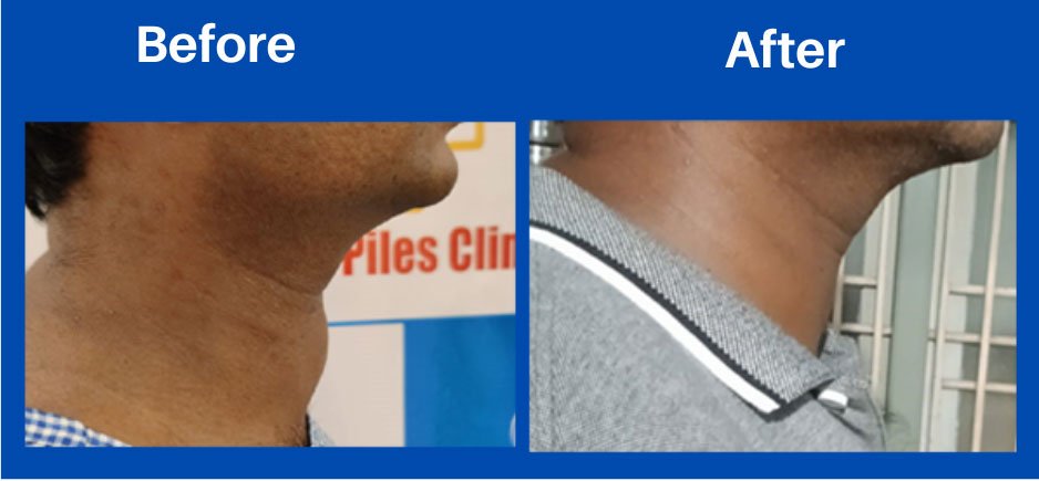 Thyroid Nodules Before After photo